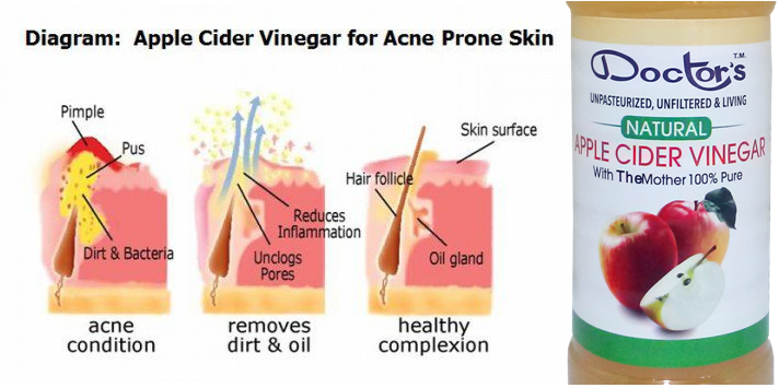 acne-prone-skin.png